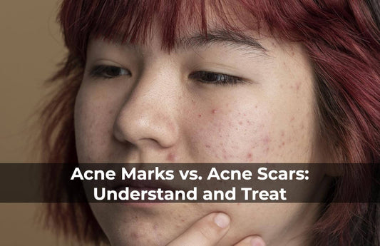 Acne Marks vs. Acne Scars: Understand and Treat - STRICTLY ORGANICS