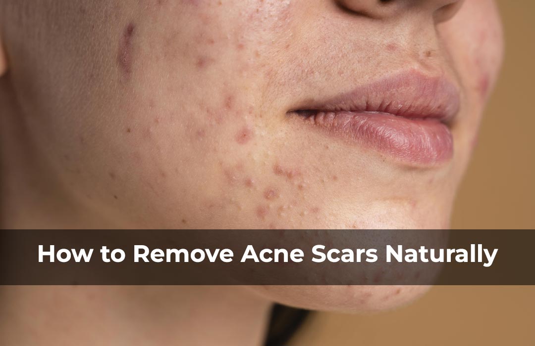 How to Remove Acne Scars Naturally - STRICTLY ORGANICS